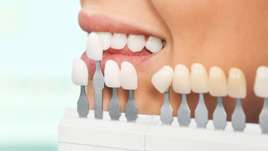 Dental veneers