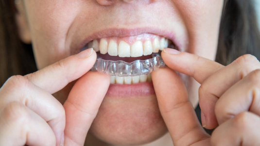 clear aligner treatment