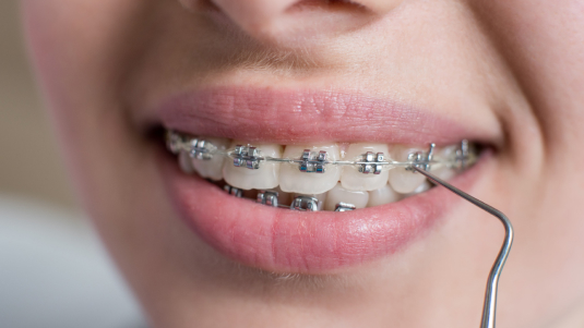 dental braces in Kerala