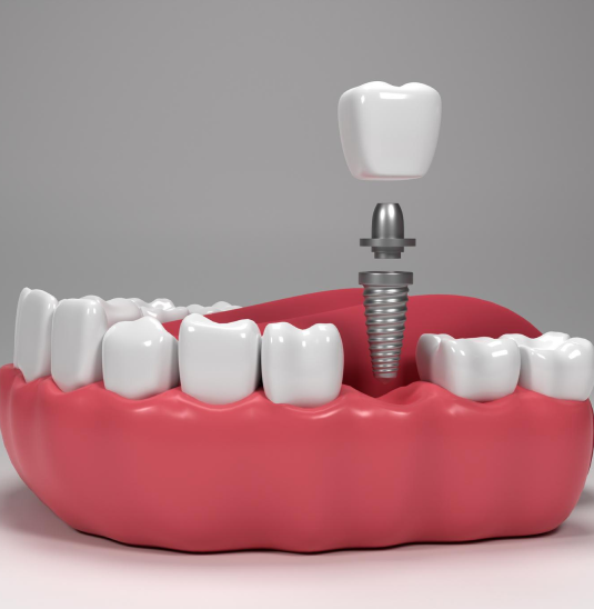 dental implants