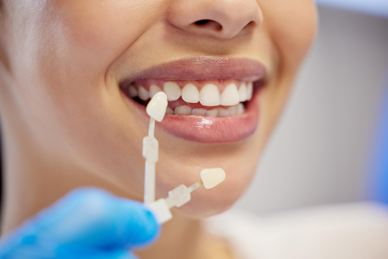 dentalveeners