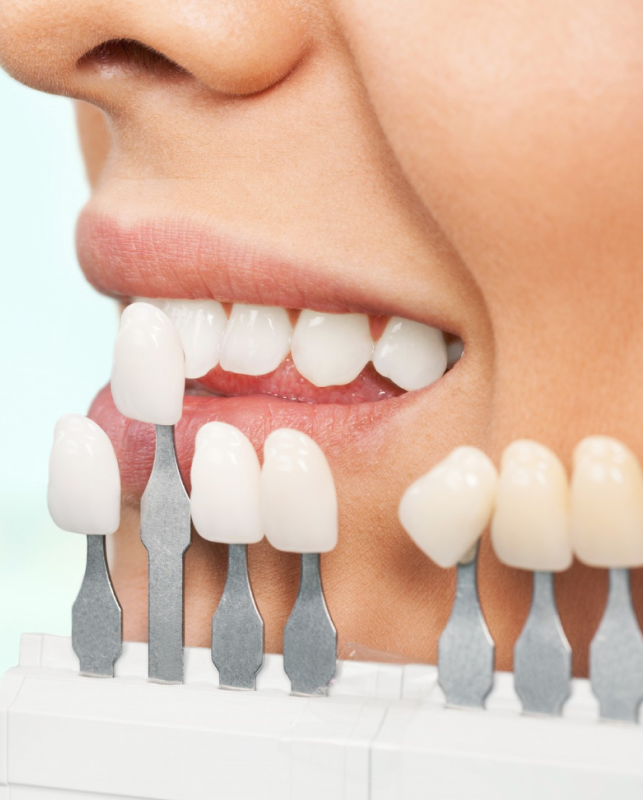 dental veneers cost in kerala