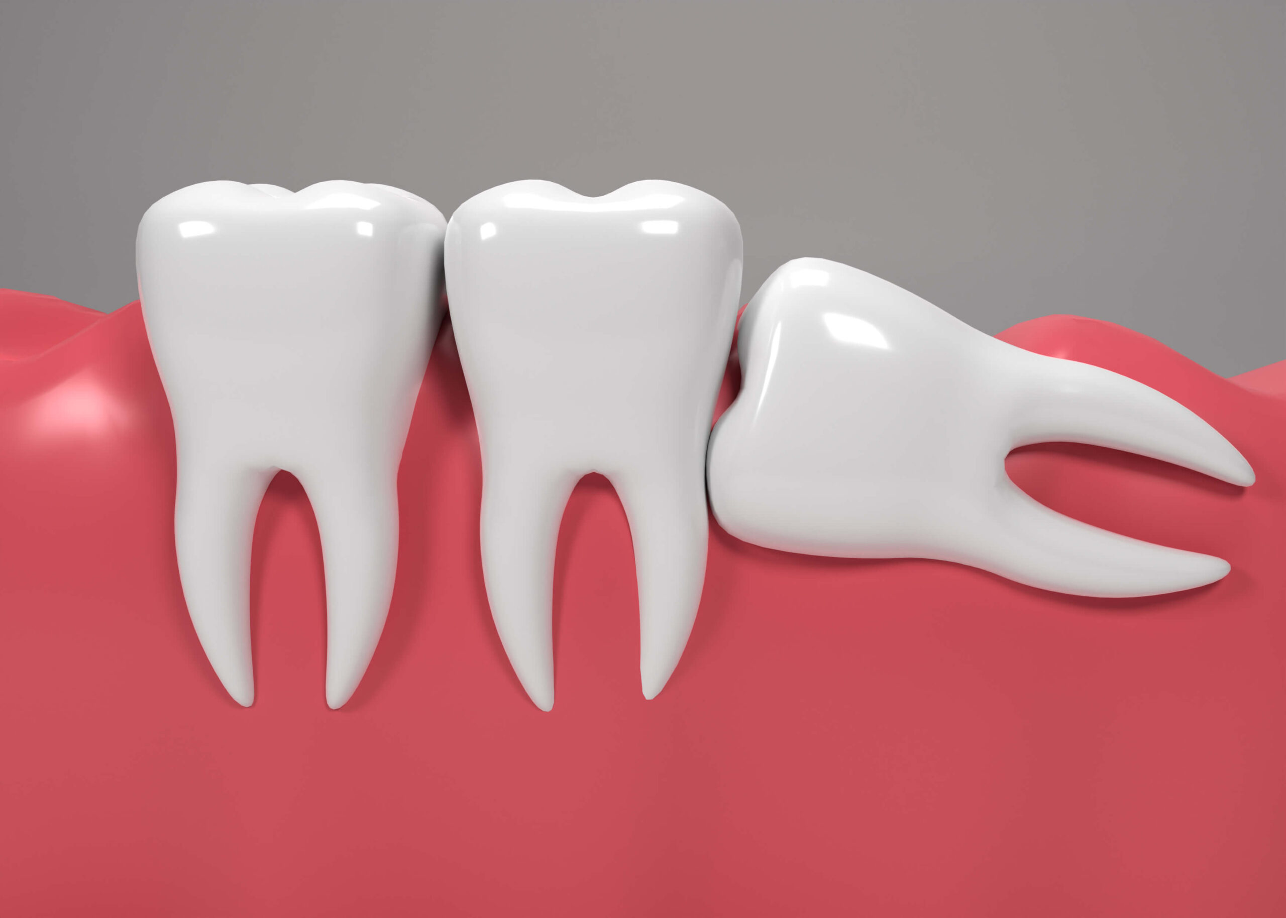 wisdom tooth
