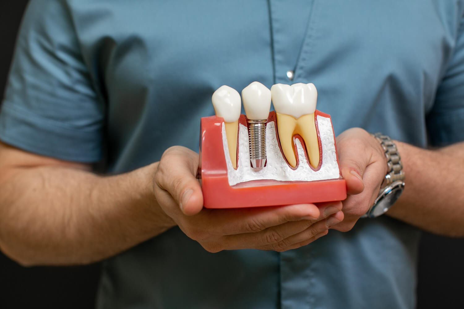 dental implants cost