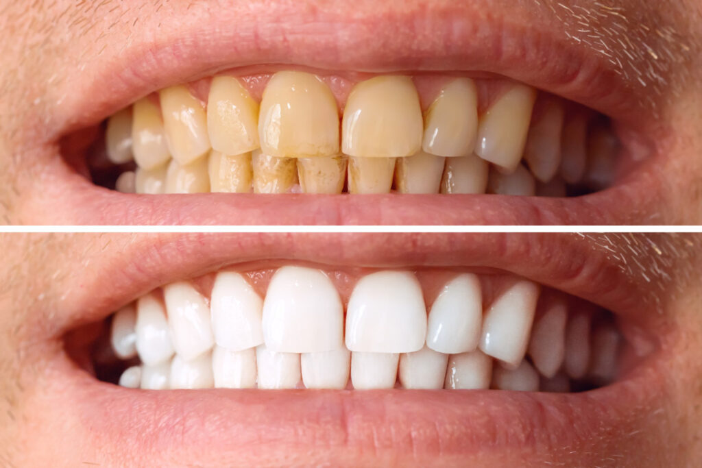 before and after tooth whitening