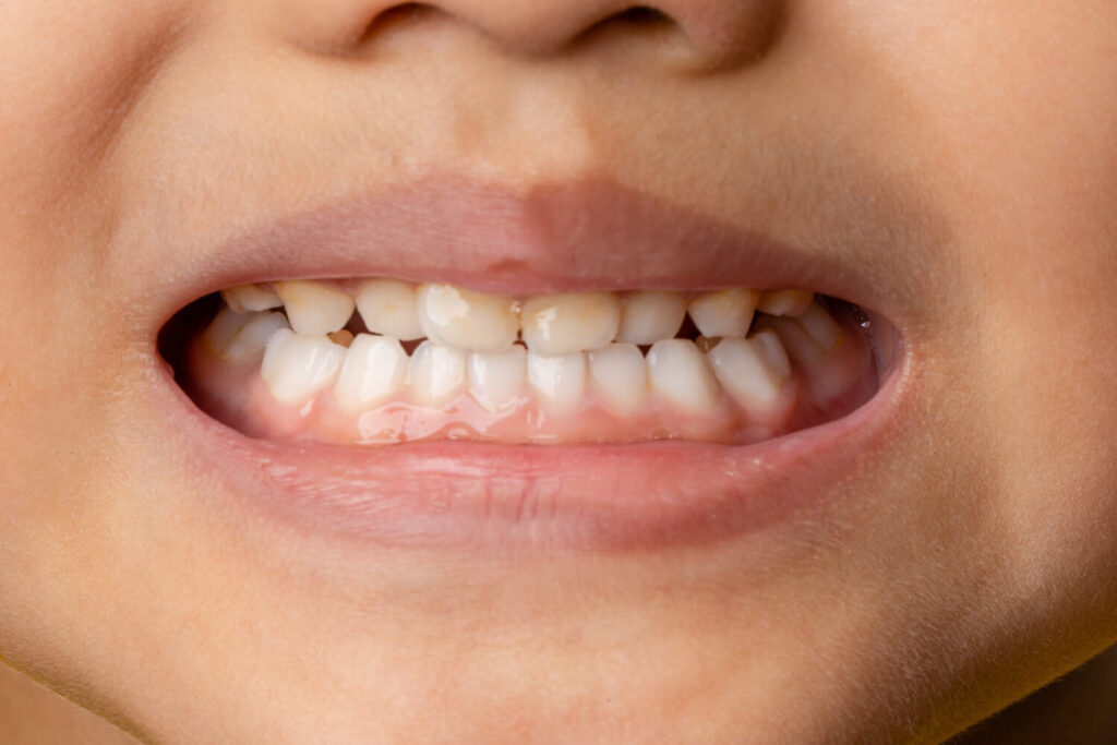 crowded teeth