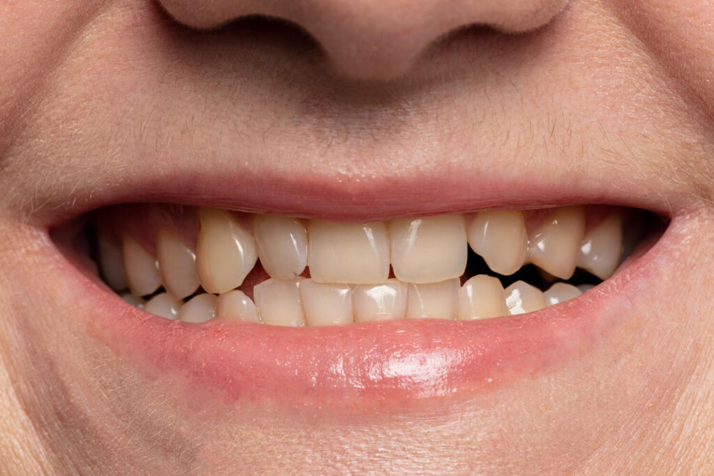 crowded teeth