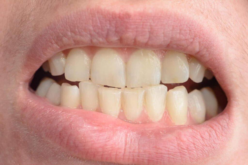 crowded teeth