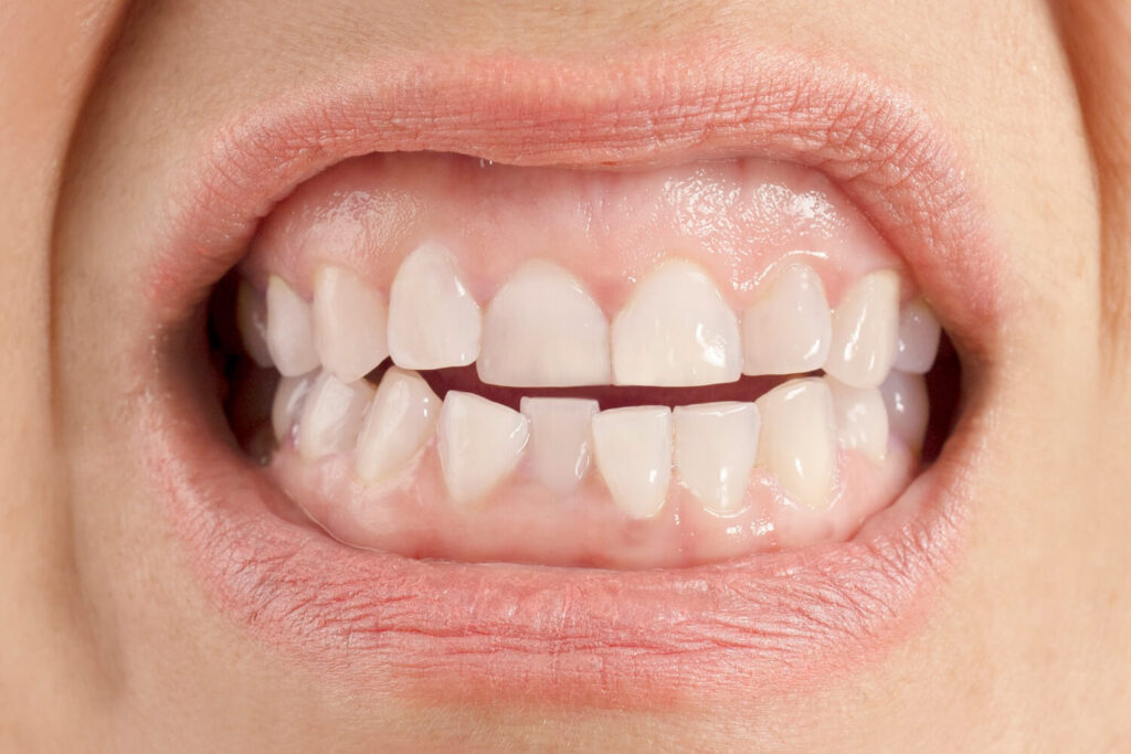 crowded teeth