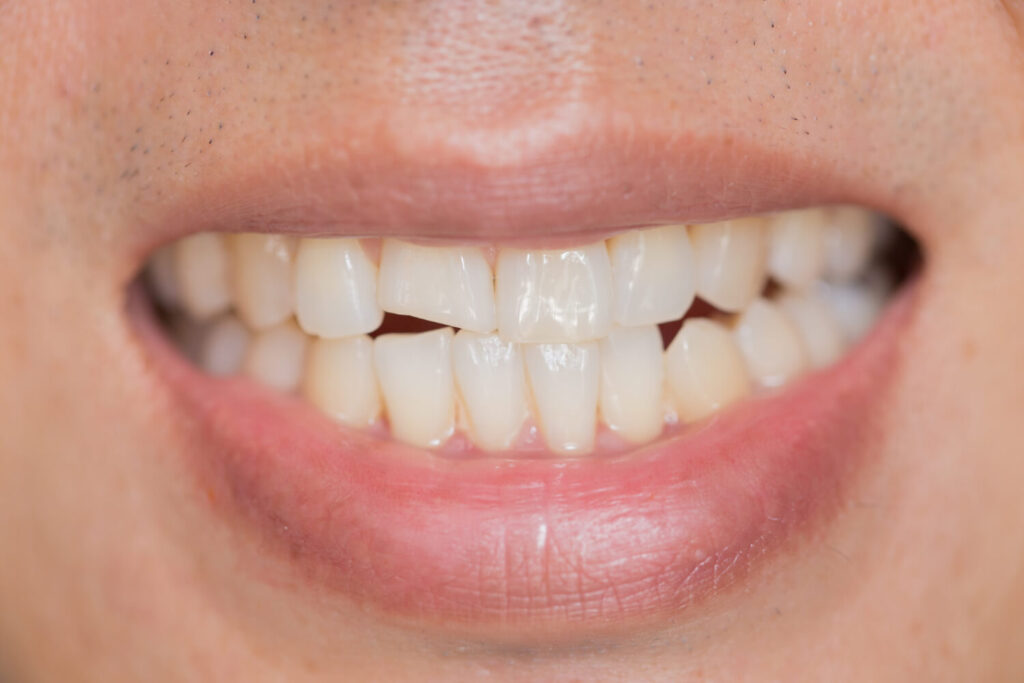 aligner for crowded teeth