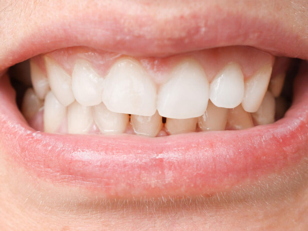 crowded teeth