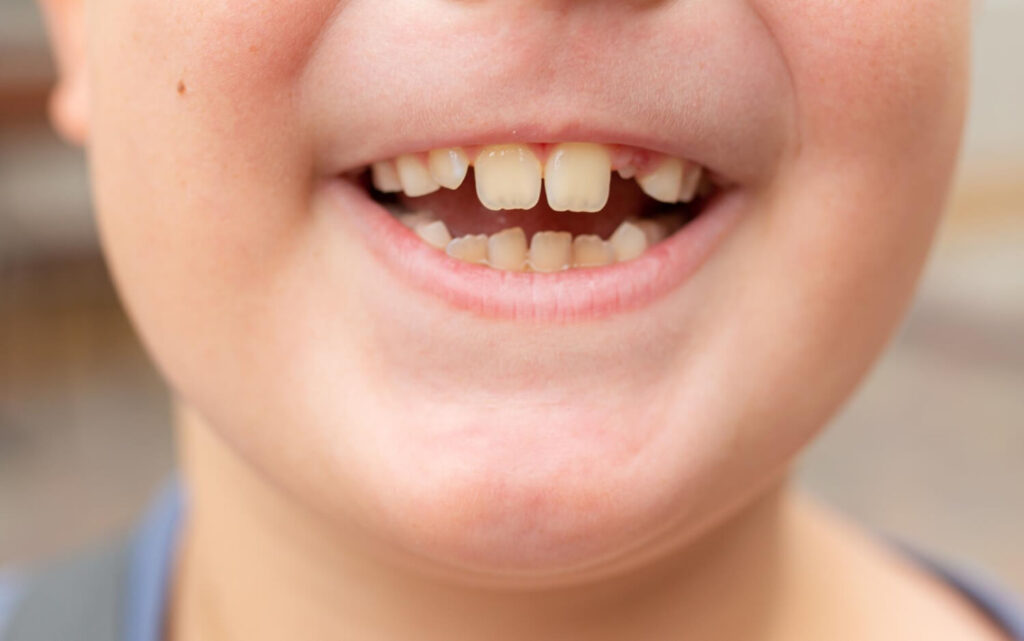 buck teeth