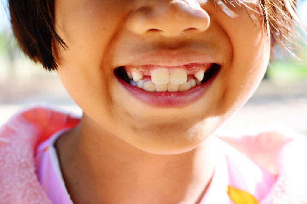 buck teeth