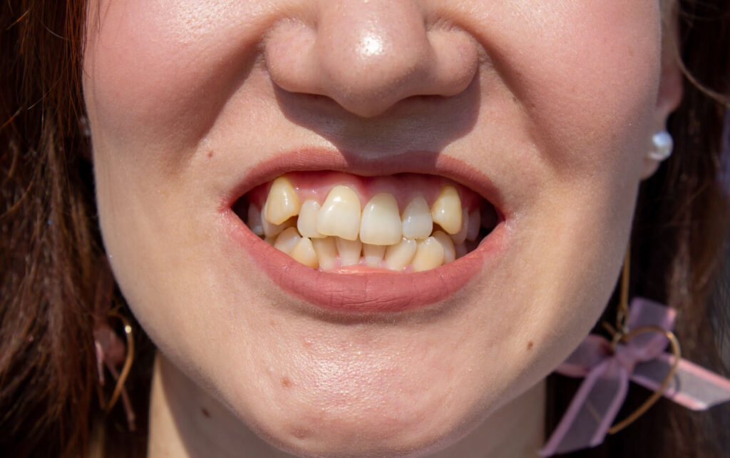 buck teeth