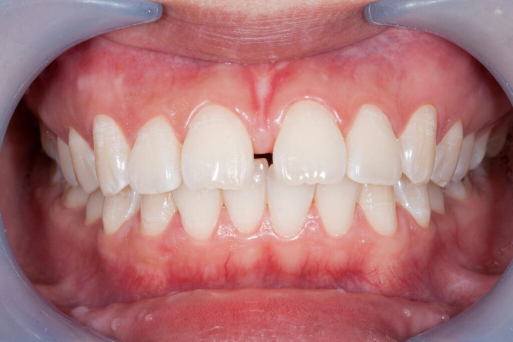 teeth gap