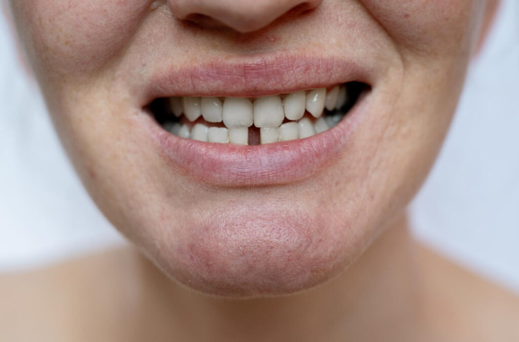 teeth gap aligner