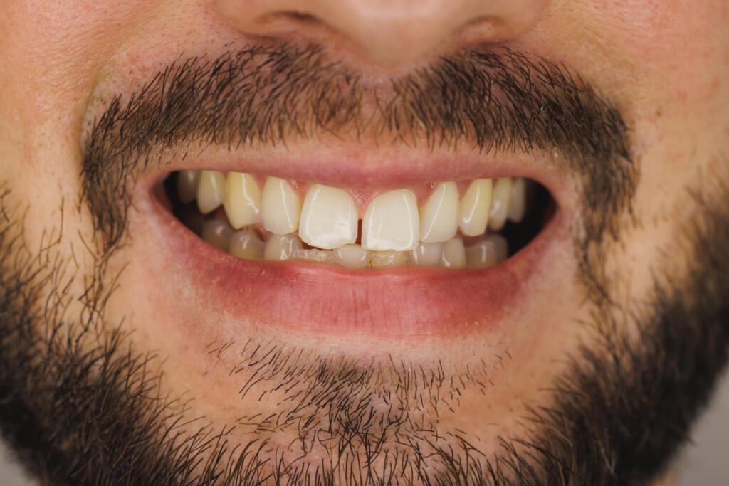 teeth gap