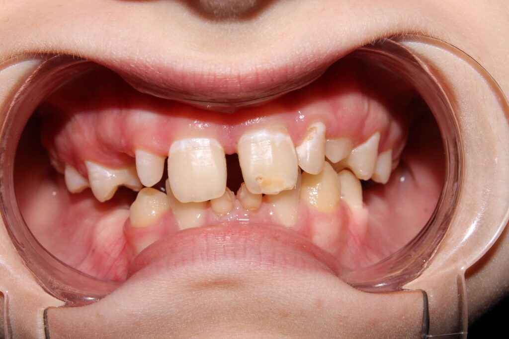 teeth gap