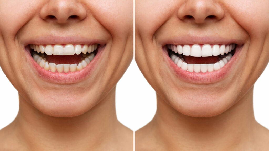veneertreatment