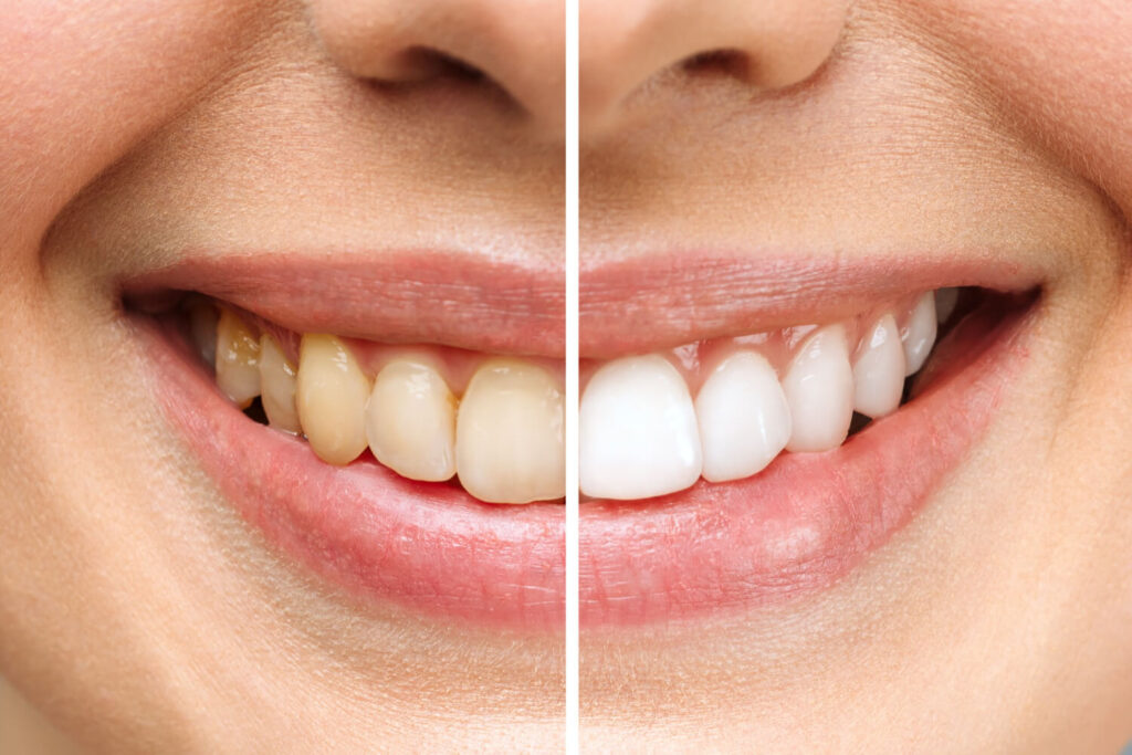 Whitening Application in teeth whitening treatment