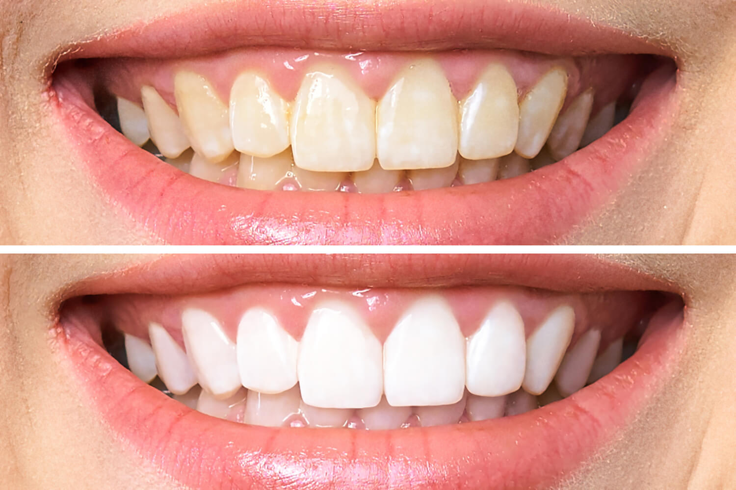 reasons for yellow teeth