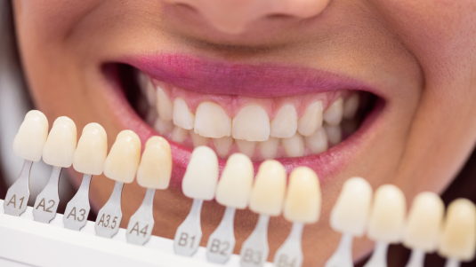 Dental veneers